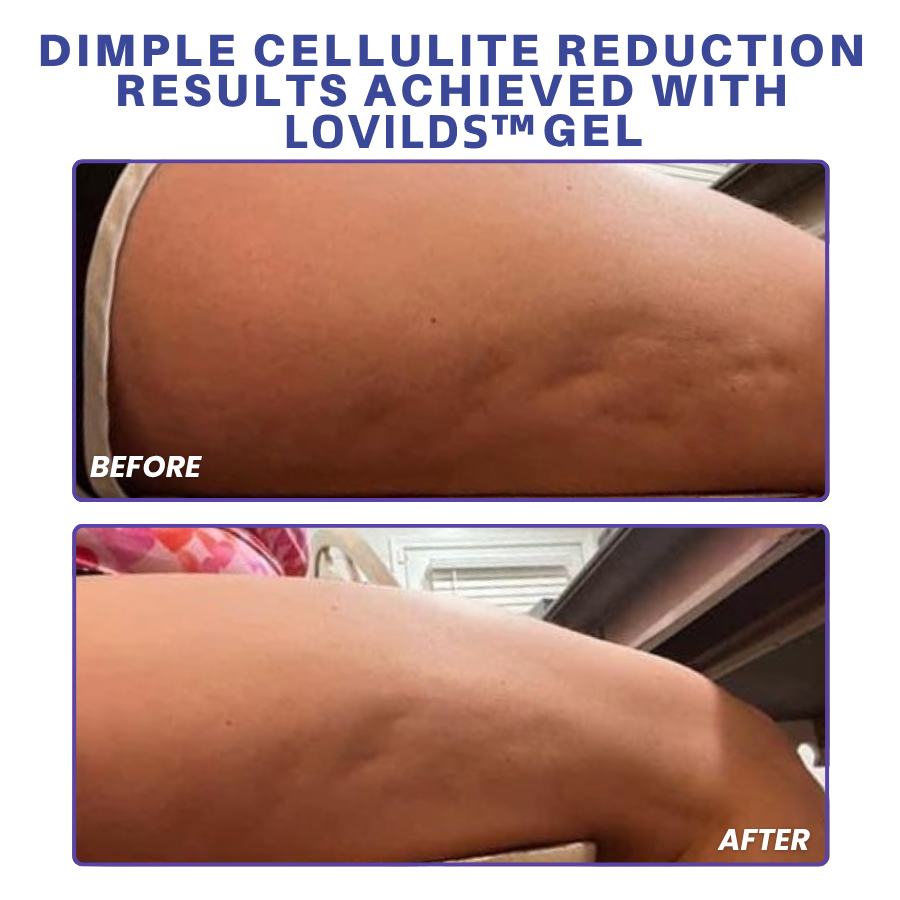 LOVILDS™ PDRN-GLP-1 Cellulite Targeting Reedle Shot Gel