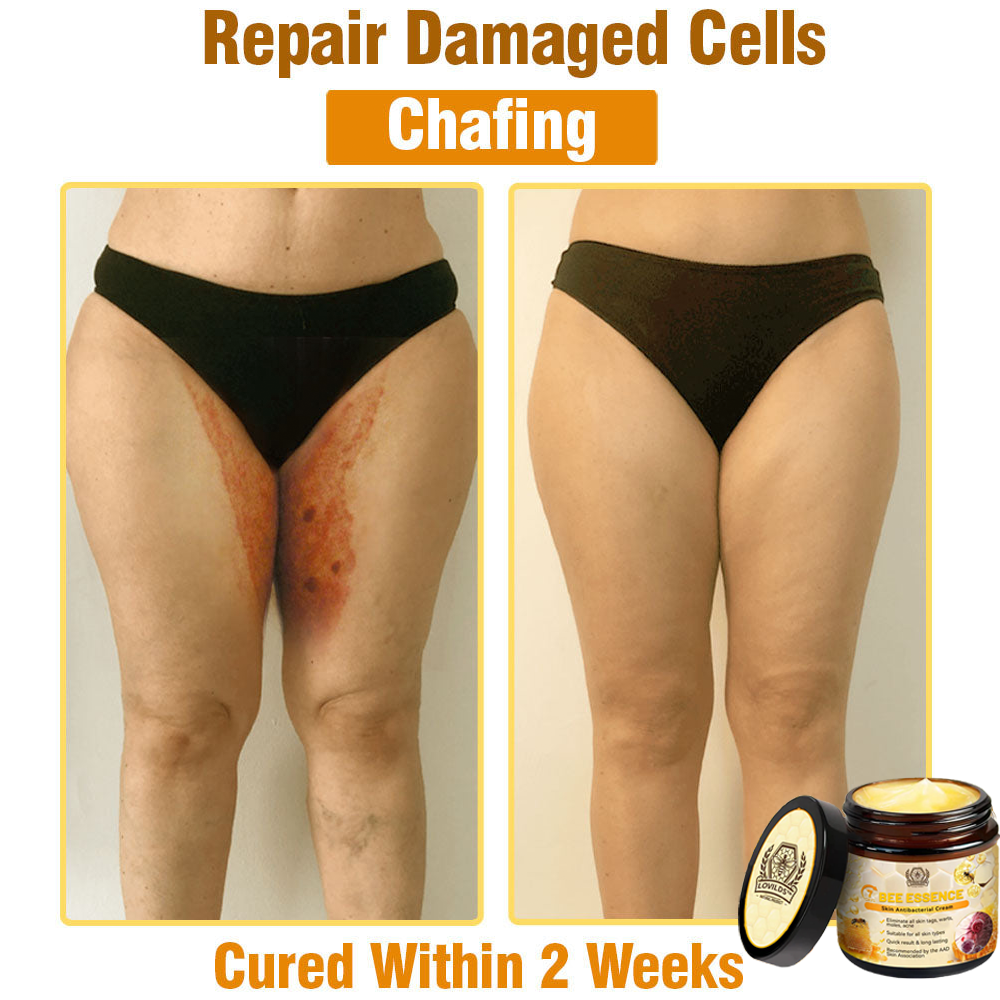 LOVILDS™ Bee Essence Skin Antibacterial Cream—used to treat a variety of skin diseases (AAD recommended).