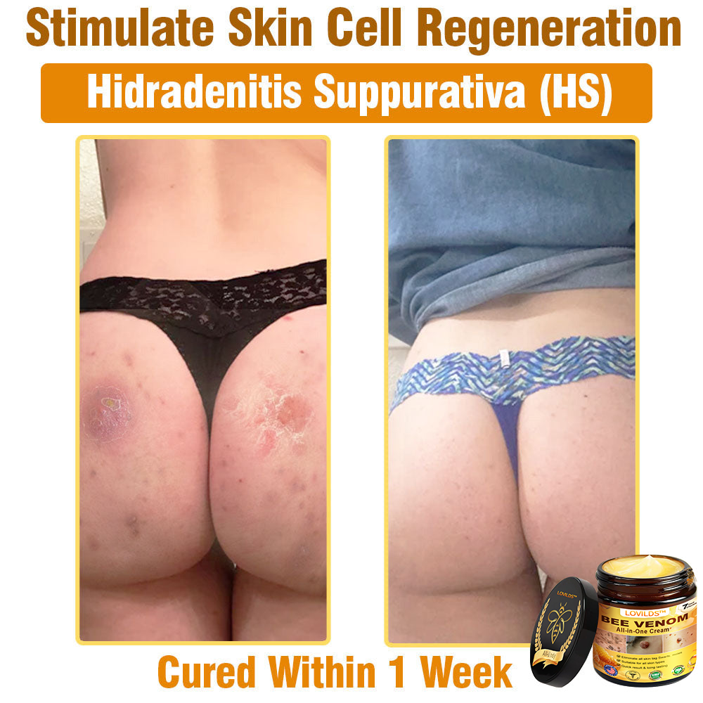 LOVILDS™ Bee Venom All-in-One Cream 👩⚕️US Dermatologist Approved