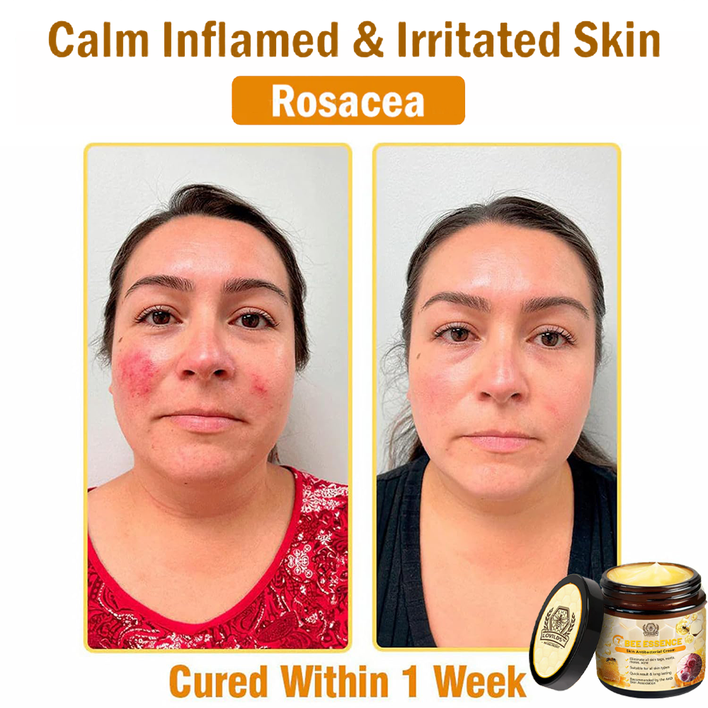 LOVILDS™ Bee Essence Skin Antibacterial Cream—used to treat a variety of skin diseases (AAD recommended).