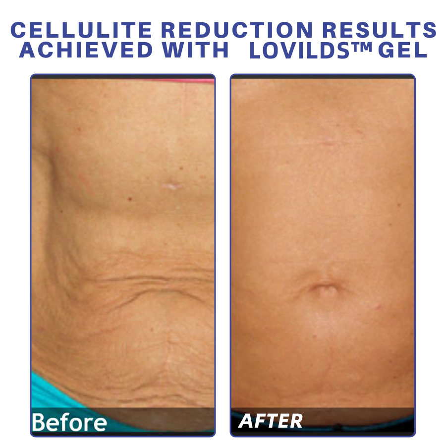 LOVILDS™ PDRN-GLP-1 Cellulite Targeting Reedle Shot Gel