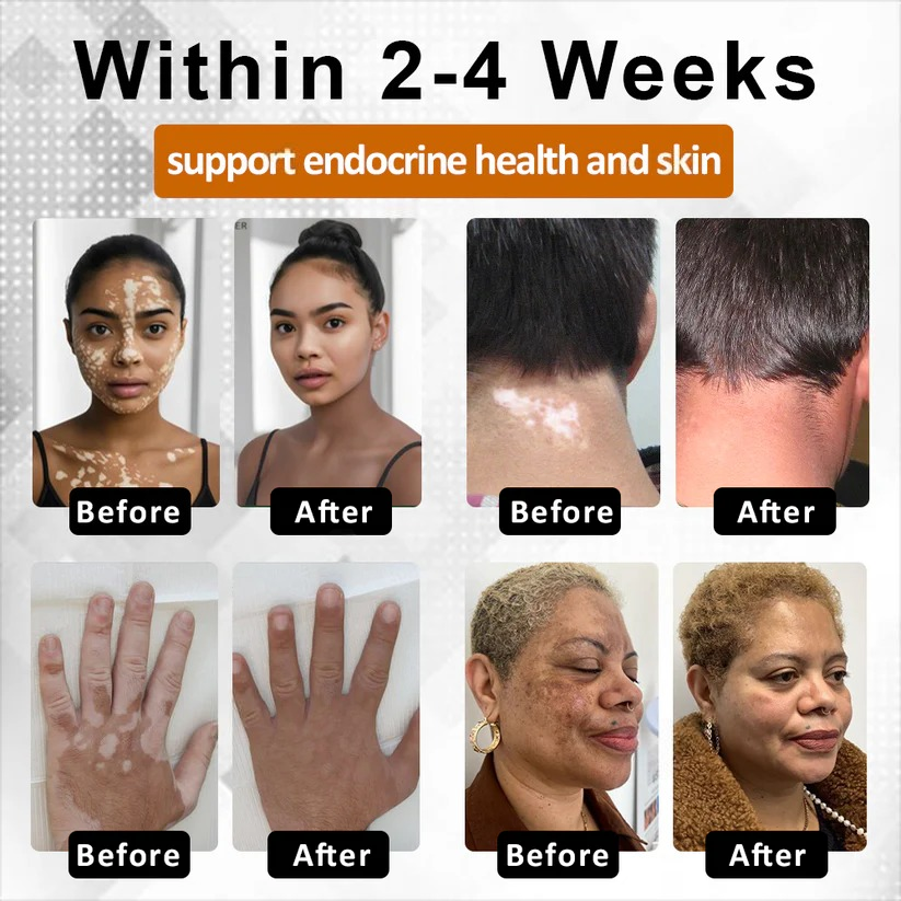 Alisanda™VitiBee Skin Rebalancing Cream US Dermatologist Approved