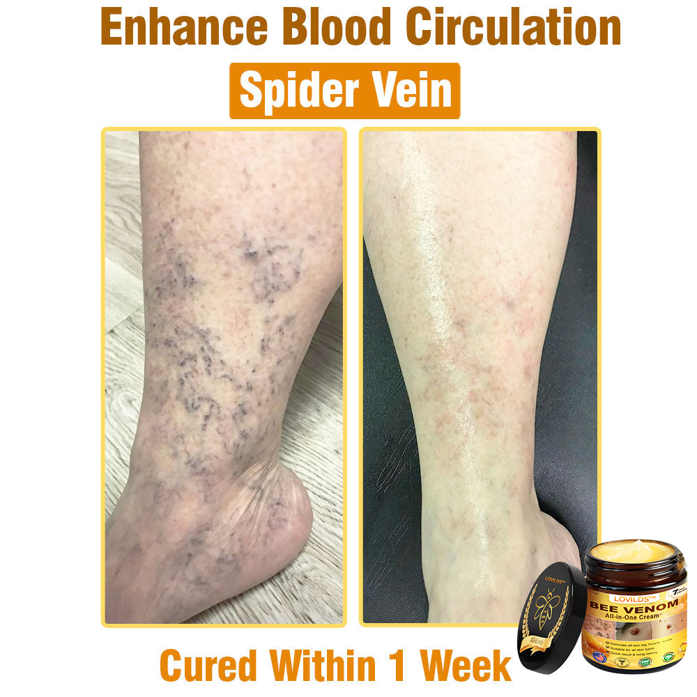LOVILDS™ Bee Venom All-in-One Cream 👩⚕️US Dermatologist Approved