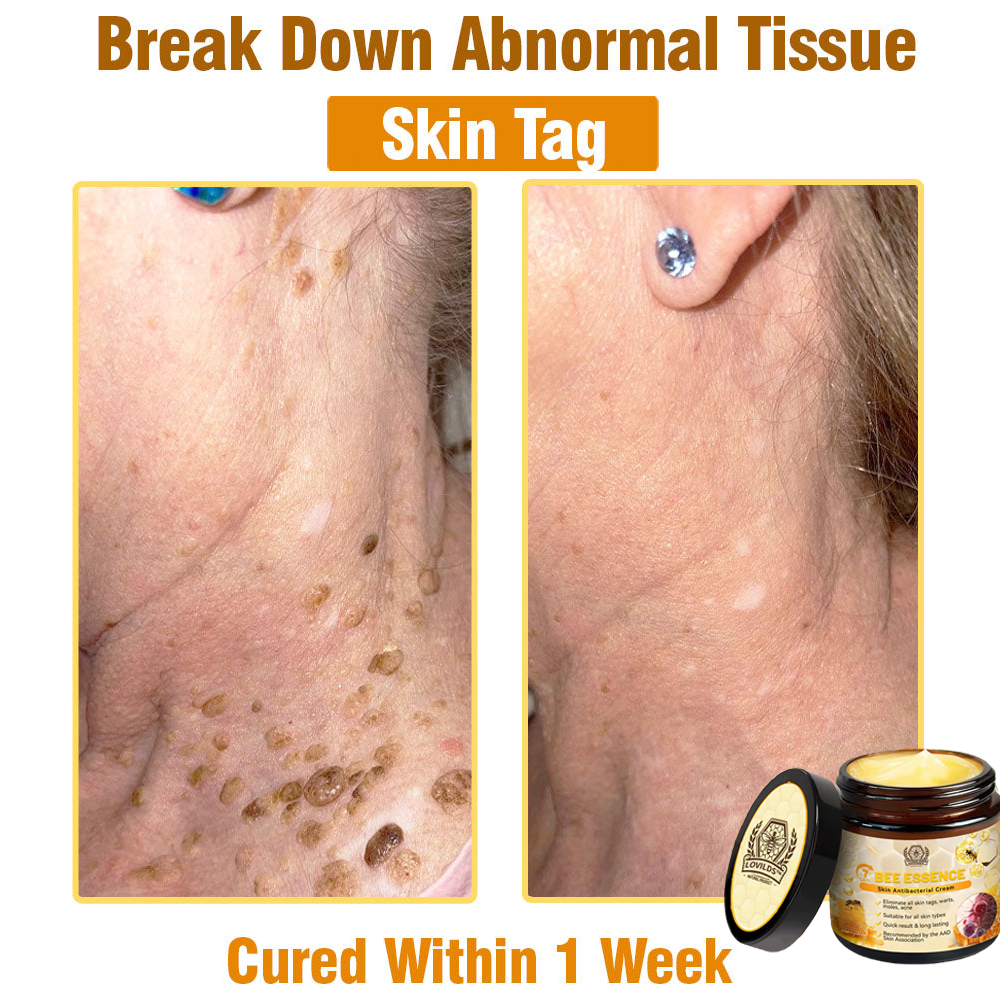 LOVILDS™ Bee Essence Skin Antibacterial Cream—used to treat a variety of skin diseases (AAD recommended).