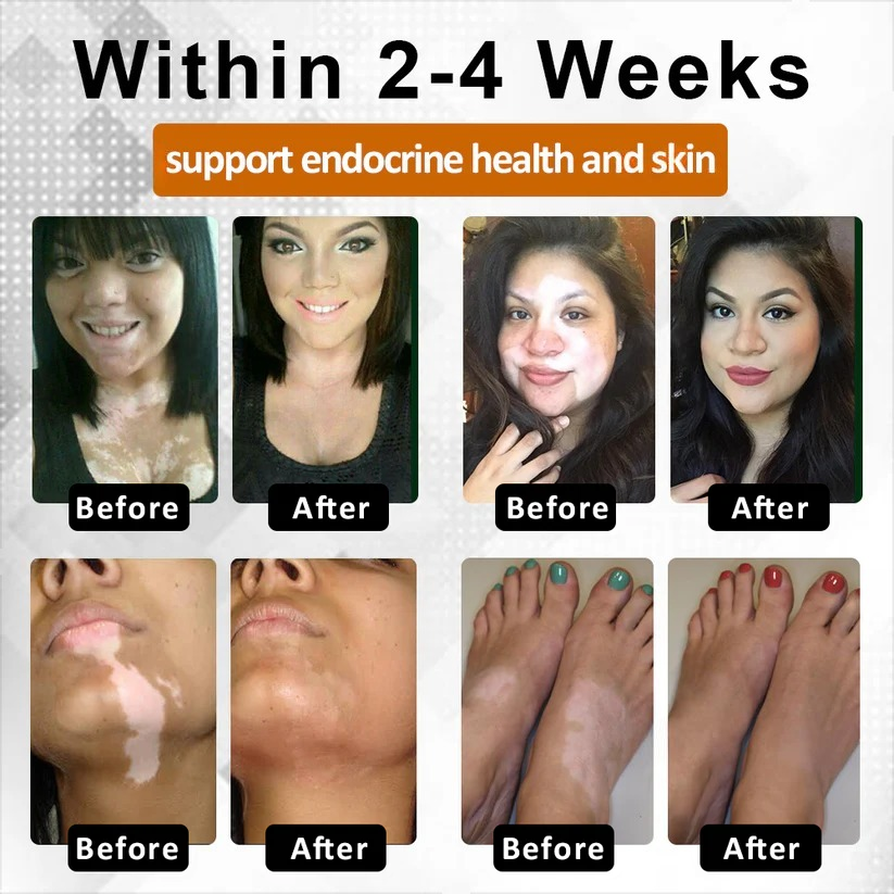 Alisanda™VitiBee Skin Rebalancing Cream US Dermatologist Approved