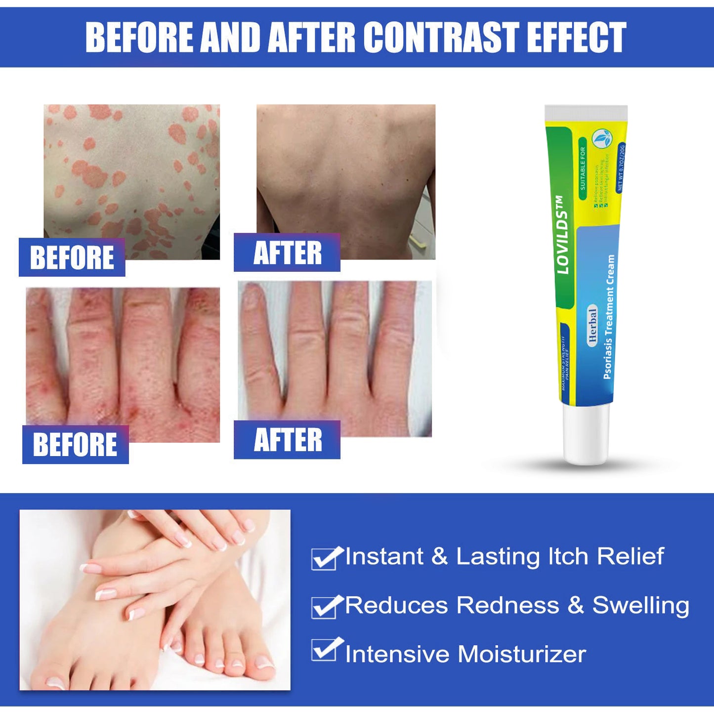 ļ¼š„Buy 2 Get 1 Freeš„ļ¼LOVILDSā¢Herbal Psoriasis Treatment Cream