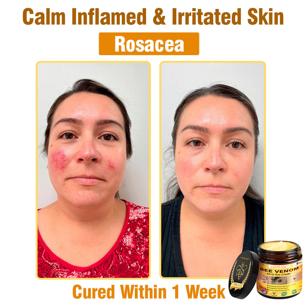 LOVILDS™ Bee Venom All-in-One Cream 👩⚕️US Dermatologist Approved