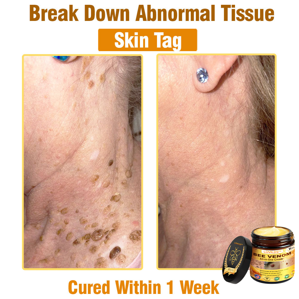 LOVILDS™ Bee Venom All-in-One Cream 👩⚕️US Dermatologist Approved