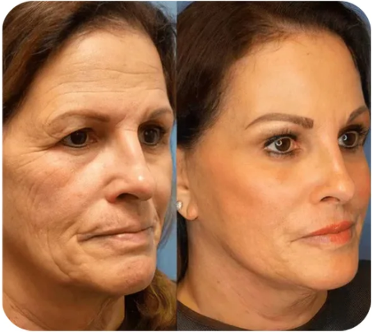 (🖤Black Friday & Christmas Double Event🎄-50%off)Replace new packing-Instant Face Tightener ✨