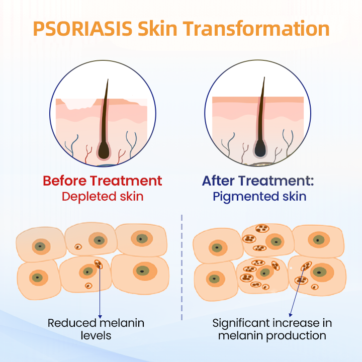 HZA™ Bee Poison PSORIASIS Care Spray