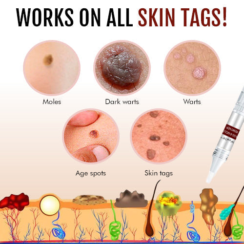 🍒BUY 1 GET 1 FREE🍒LOVILDS™ Tags & Moles Remover