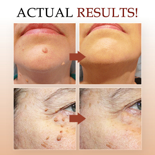 🍒BUY 1 GET 1 FREE🍒LOVILDS™ Tags & Moles Remover