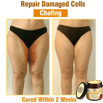 LOVILDS™ Bee Essence Skin Antibacterial Cream—used to treat a variety of skin diseases (AAD recommended).