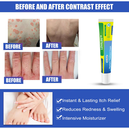 （🔥Buy 2 Get 1 Free🔥）LOVILDS™Herbal Psoriasis Treatment Cream