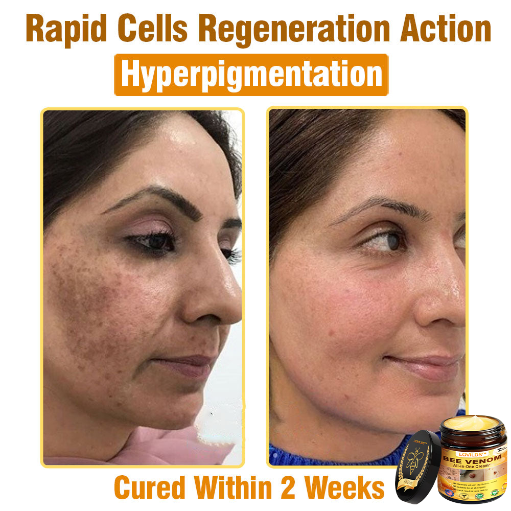 LOVILDS™ Bee Venom All-in-One Cream 👩‍⚕️US Dermatologist Approved