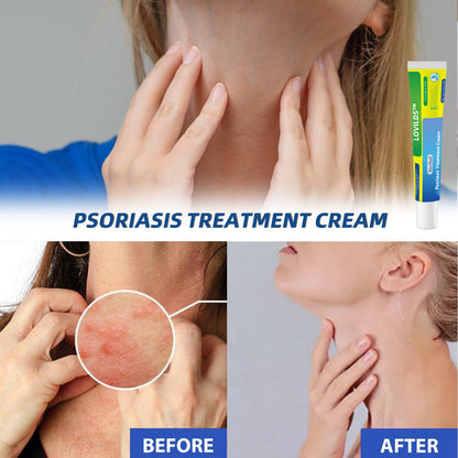 （🔥Buy 2 Get 1 Free🔥）LOVILDS™Herbal Psoriasis Treatment Cream