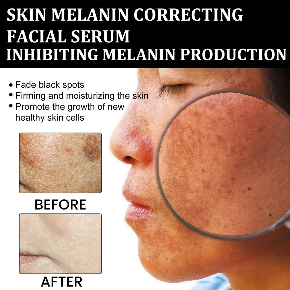✨Fast Dark Spot Remover-AQA™  Melanin Correcting Facial Serum(🔥Last Day Promotion 60% OFF)